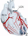 (an apical <b>infarct</b>) after