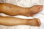 <b>Edema</b> and Swelling Problems