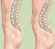 <b>Lordosis</b> is an exaggerated