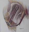 <b>Femoral Head</b> in Patients