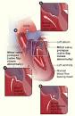 <b>Mitral Valve Prolapse</b>