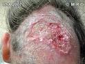 typical Morgellons patient