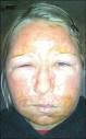 Holly Nuttall went into a British Salon for a Face Peel and suffered a ... - holly2_280x450_8810a_2