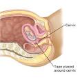 <b>Pregnancy</b> and Childbirth: <b>Abdominal</b> Cerclage - University of