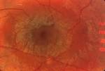 Macula in <b>Usher syndrome</b>