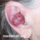 MerkelCellCarcinomaEarImage2.