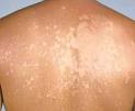 <b>Tinea Versicolor</b> - treatment