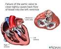 <b>Aortic insufficiency</b>