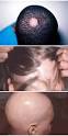 <b>Alopecia Areata</b> - Maria