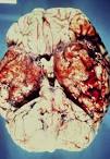 <b>Encephalitis</b>