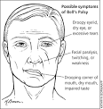 Bell Palsy