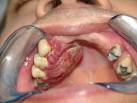 Câncer de <b>Boca</b>