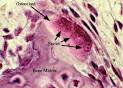 USMLE Pathology Slides - <b>Osteoclasts Osteoclasts</b> originate from...
