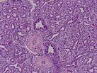<b>mucinous adenocarcinoma</b> is