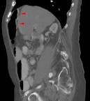 File:Chilaiditi-<b>Syndrom</b> in der