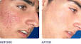 Acne Treatment. Photos courtesy of: Michael Shohat, MD - acne_treatment_ba