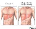 <b>Hepatomegaly</b>
