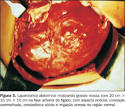 <b>Hiperplasia nodular focal</b>