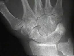 Image result for Carpal dislocation