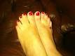 In complex <b>syndactyly</b>, the