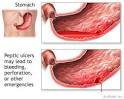 Heartburn Barrett's Esophagus - Heartburn Health Information - NY ...