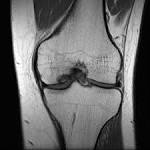 <b>Osteochondritis dissecans</b> of