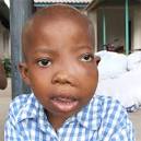 <b>Burkitt's lymphoma</b>. Causes, symptoms, treatment <b>Burkitt's lymphoma</b>