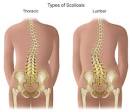 and lumbar <b>scoliosis</b>