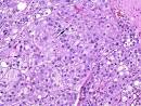 <b>Adrenal tumors</b> this large
