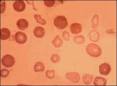<b>Talasemia</b> mayor