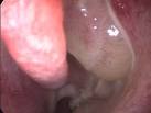 Endoscopia de fossa <b>nasal</b>