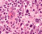 File:Anaplastic <b>large cell</b>
