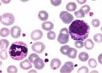 <b>leucemia</b> mieloide <b>crónica</b>.