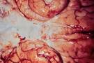What is <b>meningococcal disease</b>?