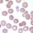 <b>Babesiosis</b> - Microscopy Findings