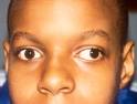 If <b>strabismus</b> is not treated