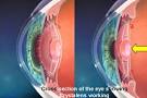Lens Implants | Premium IOL's | Contact Lens Exam | Contacts Exam