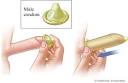 Barrier methods of birth control