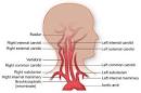 Carotid Artery Disease - Texas Heart Institute Heart Information ...