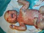 Pictures for <b>Ichthyosis</b>