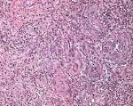 cutaneous <b>angiolymphoid hyperplasia</b> with <b>eosinophilia</b> - Humpath