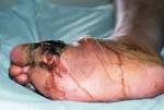 Microvascular <b>complications</b>