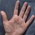 Causes of <b>Dyshidrotic Eczema</b>