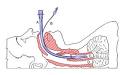 Tracheal <b>intubation</b> - Wikipedia, the free encyclopedia