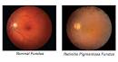 What is <b>Retinitis Pigmentosa</b>?