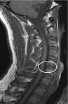 Cervical HERNIATED DISC