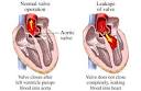 <b>aortic valve</b> regurgitation