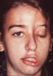 <b>PARALISIA</b> FACIAL E ACUPUNTURA