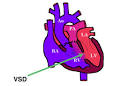 <b>Double outlet right ventricle</b>