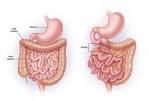 <b>Intestinal</b> malrotation with
